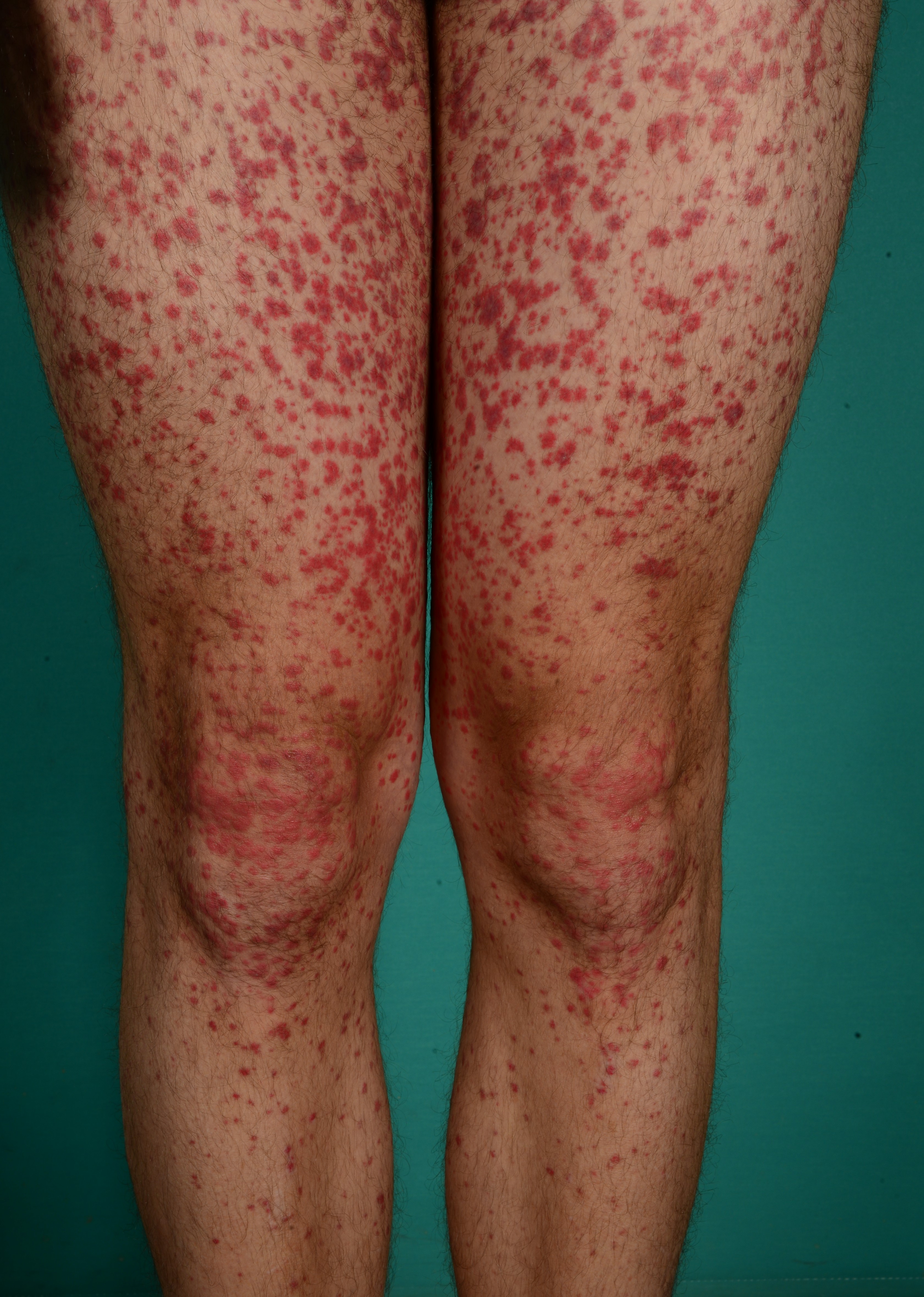 laegemiddeludslaet ben