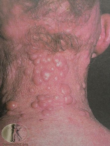 mycosis fungoides-tumoreer