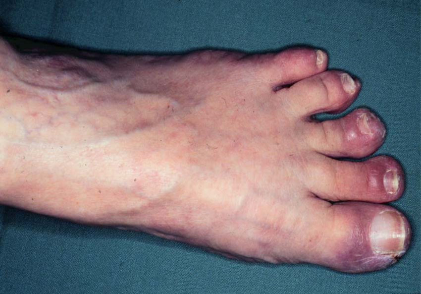 fod-hudforandringer paa foedder og taeer ved pv 2
