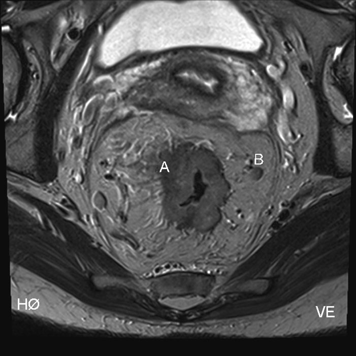 colon-colorektal cancer tvaersnit-ct