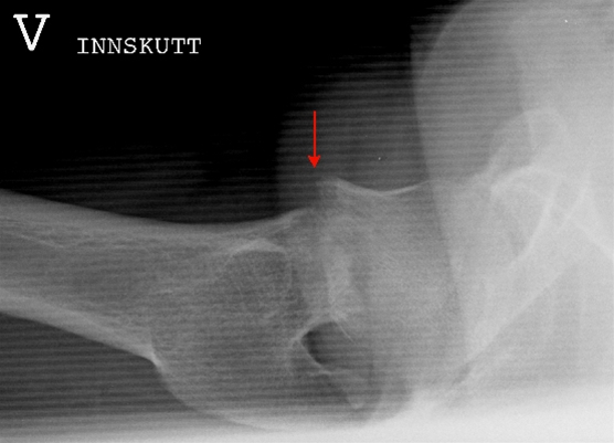 ben-collum femoris fraktur innskut-roentgen