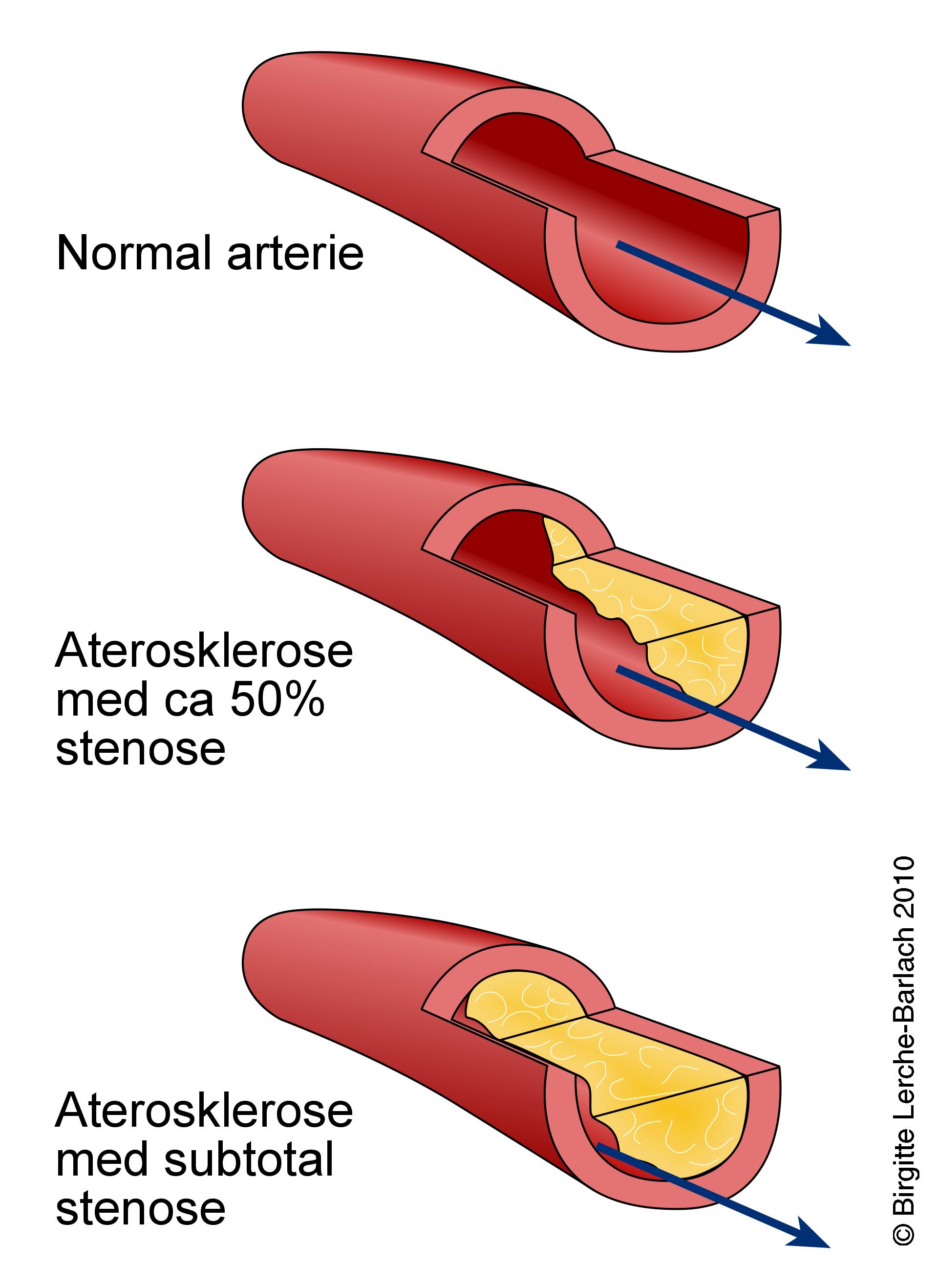 aterosklerose laengdesnit