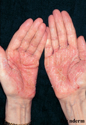 psoriasis-haender