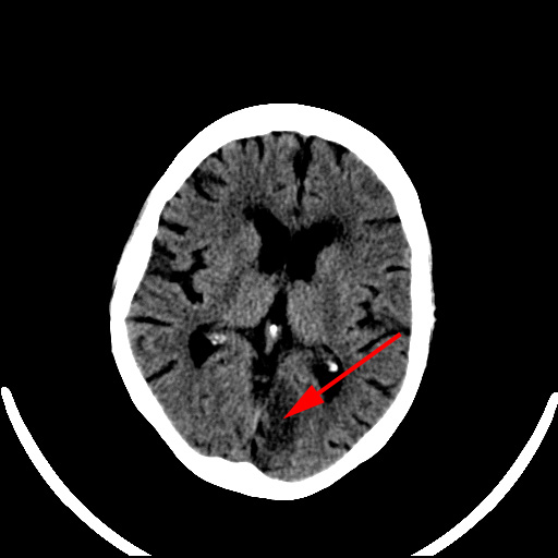 hjerne-cerebrum aeldre infarkt-ct