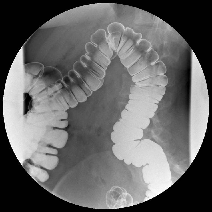 colon-normal-rtg kontrast og luft