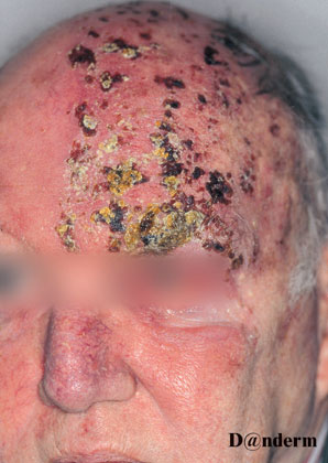 Herpes zoster hoved dok id 247