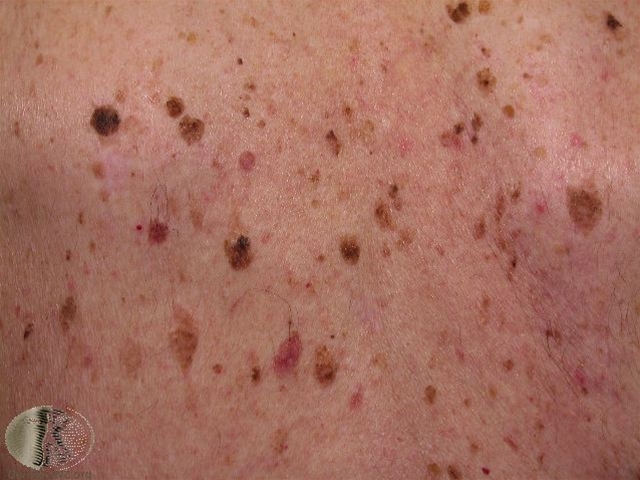 4197 2 seboroiske vorter 1 jpg