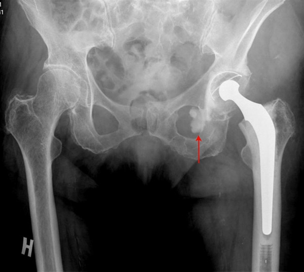 hofte-totalprotese-roentgen