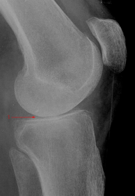 knae-gigt-gonartrose-moderat side-rtg