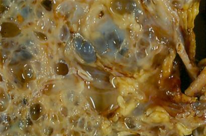 nyre-snitflade af polycystisk nyre