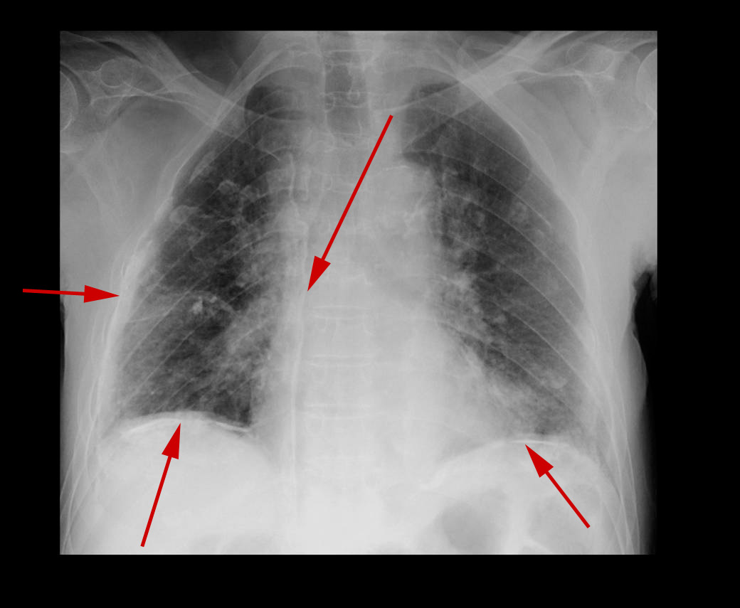 lunger-asbest-rtg frontal