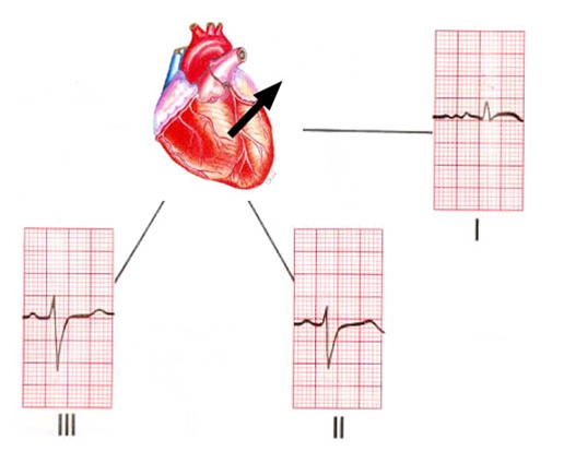 hjerte-venstre aksedeviation ekg
