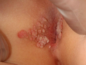 Anogenitale kondylomer