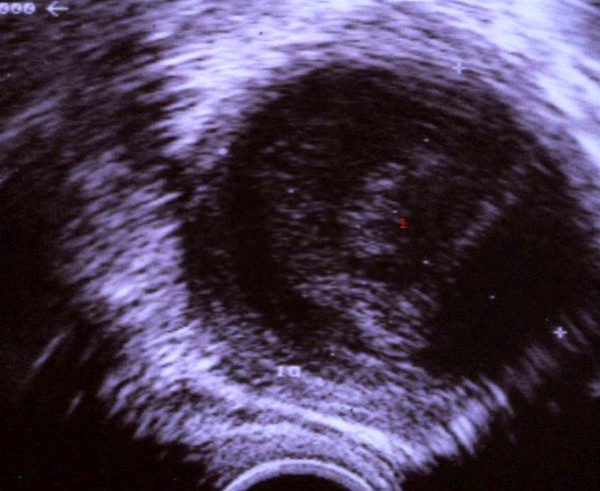 livmoder-tuboovariel byld-ultralyd