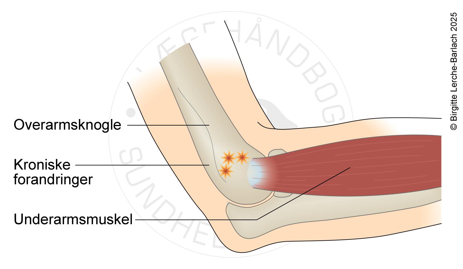 LH_id59 Lateral epikondylitis