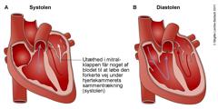 Tegning af hjerte med mitralinsufficiens.