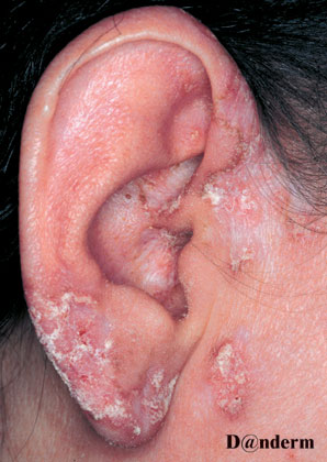 disskoid-lupus-i-øret