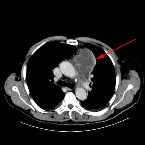 lunger-lungetumor-ct (1)