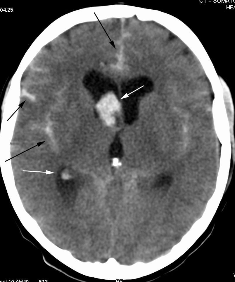 hjerne-subaraknoidalbloedning-ct