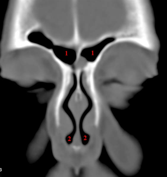 ansigt- frontalsinus coronal-ct