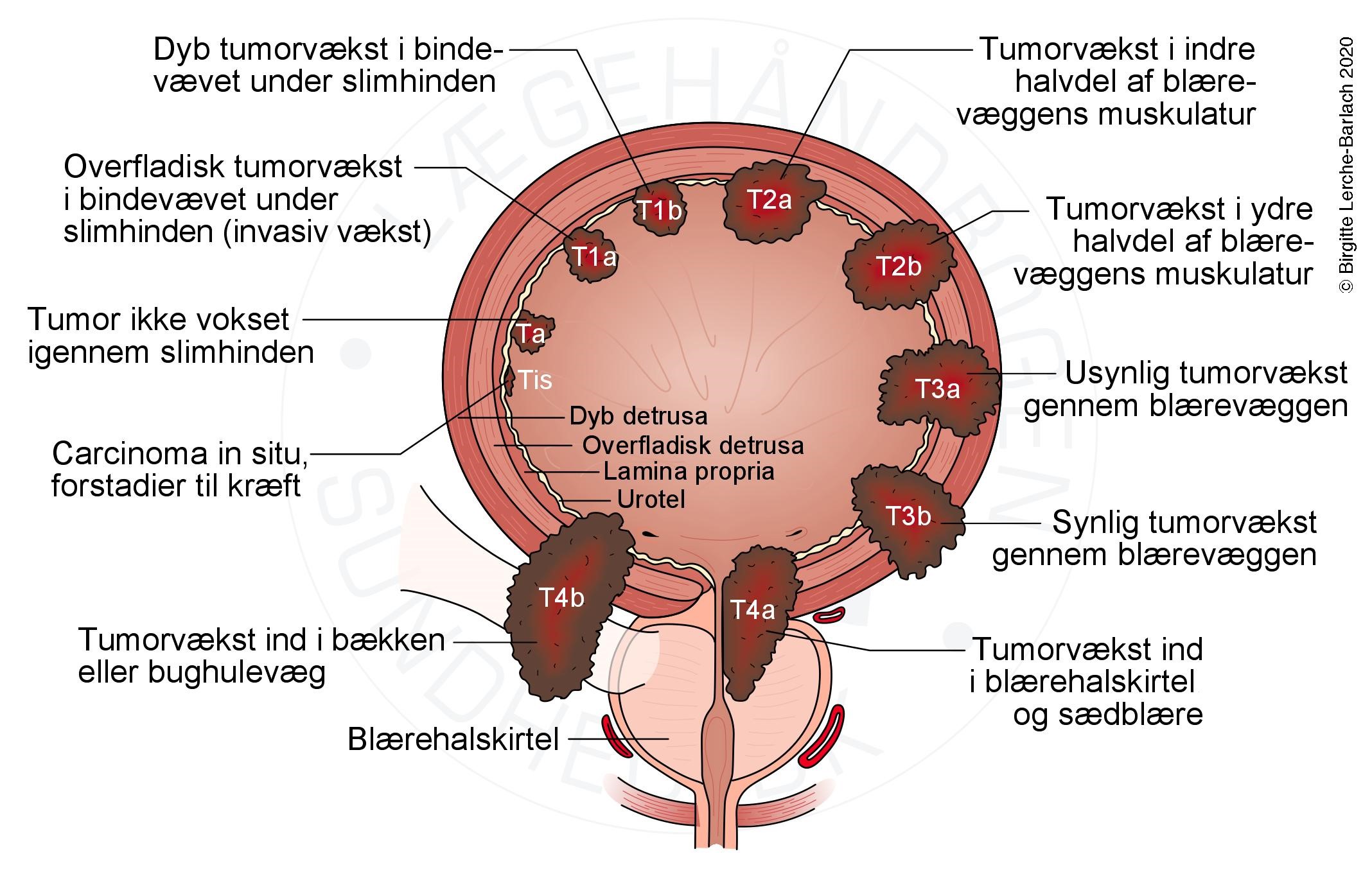 blaere-blaeretumorer