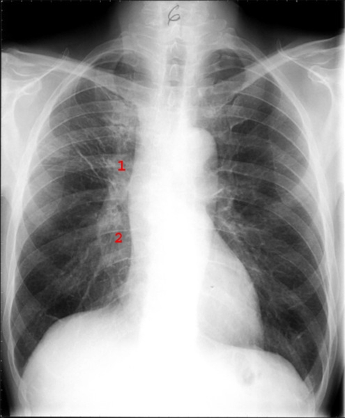 lunger-smaacellet anaplastisk carcinom efter behandling-roentgen