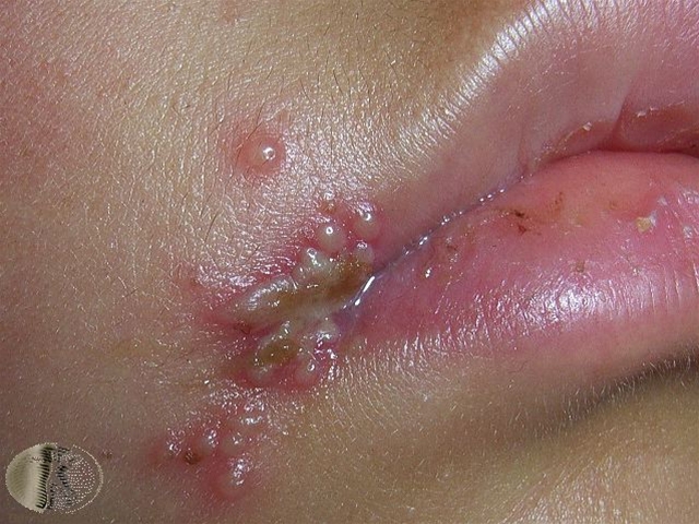 herpes simplex labialis2