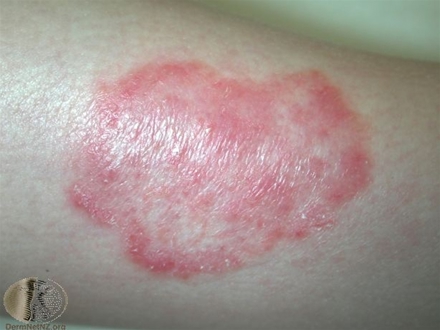 tinea corporis-2