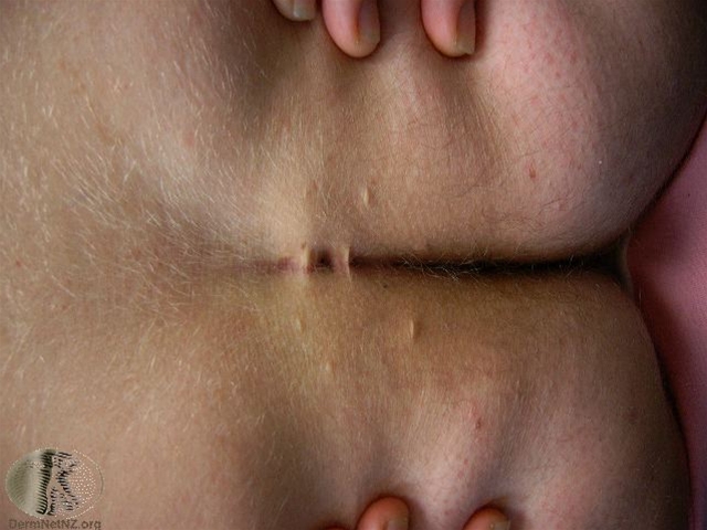 pilonidalsygdom-baller