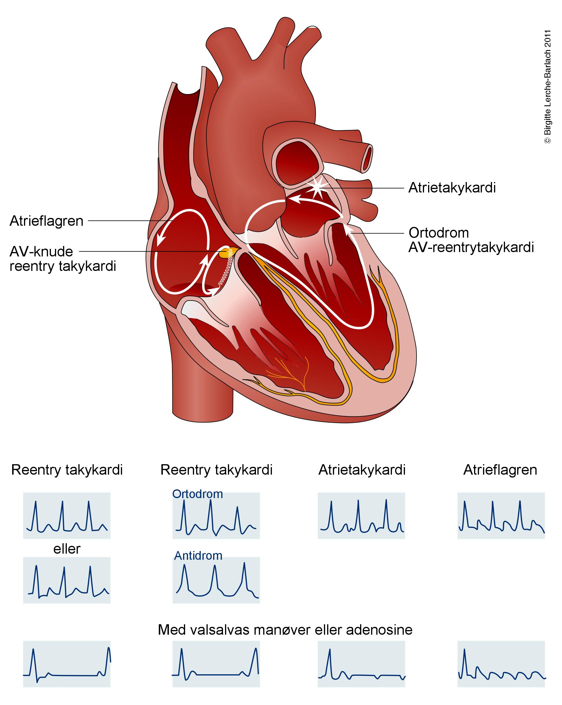 hjerte-supraventrikulaer takykardi