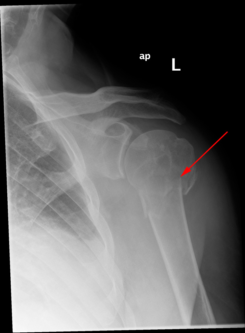 skulder-collum chirurgicum fraktur-roentgen