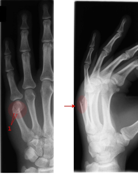 haand-metacarp 5 fraktur-roentgen