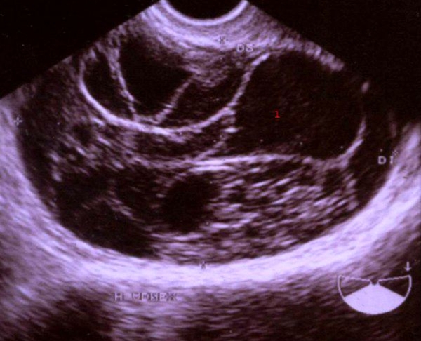 aeggestok-mucinoest cystadenom-ultralyd