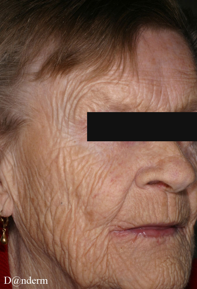 irrant angular cheilitis danderm