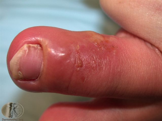 herpes simplex whitlow (1)