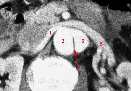 aorta-dissektion axial-ct