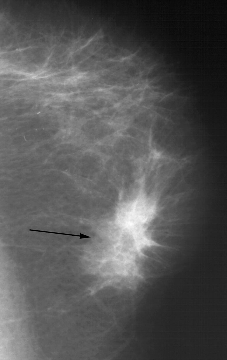 bryst-kraeft-mammografi