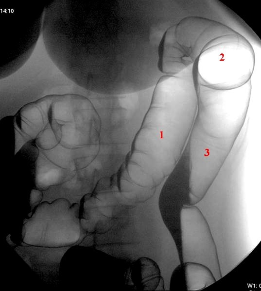 colon-venstre flexur-roentgen