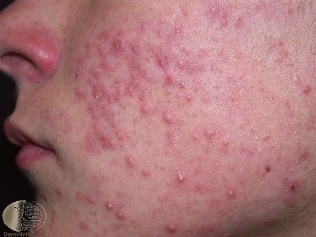 ansigt-udslaet akne