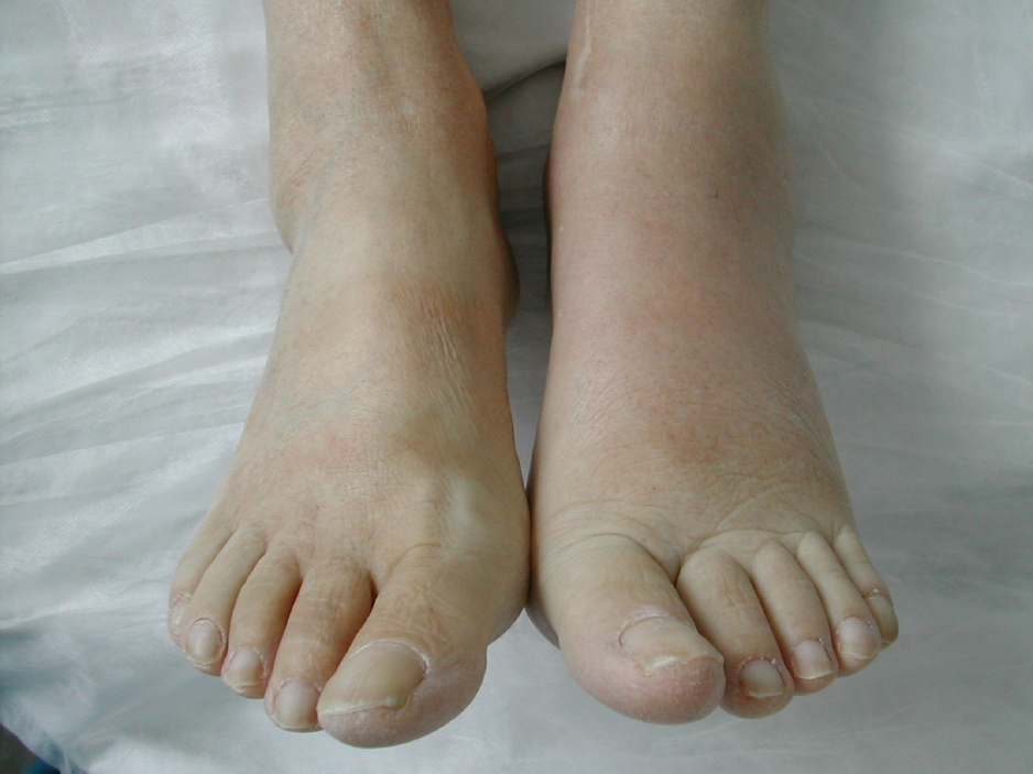 foedder-akutte charcots fod front