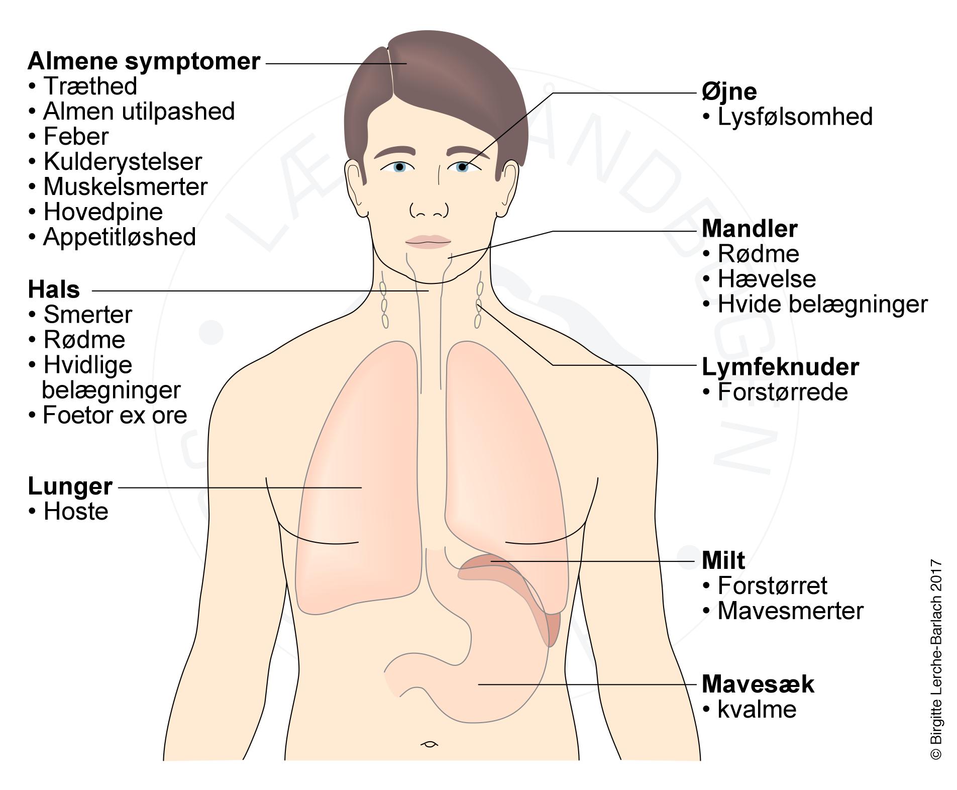 hovedsymptomer ved mononukleose