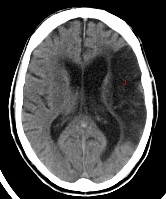 hjerne-cerebralt infarkt media-ct