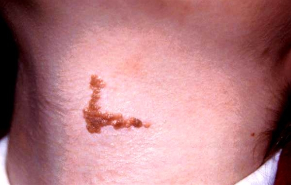 naevus medfoedt epidermal