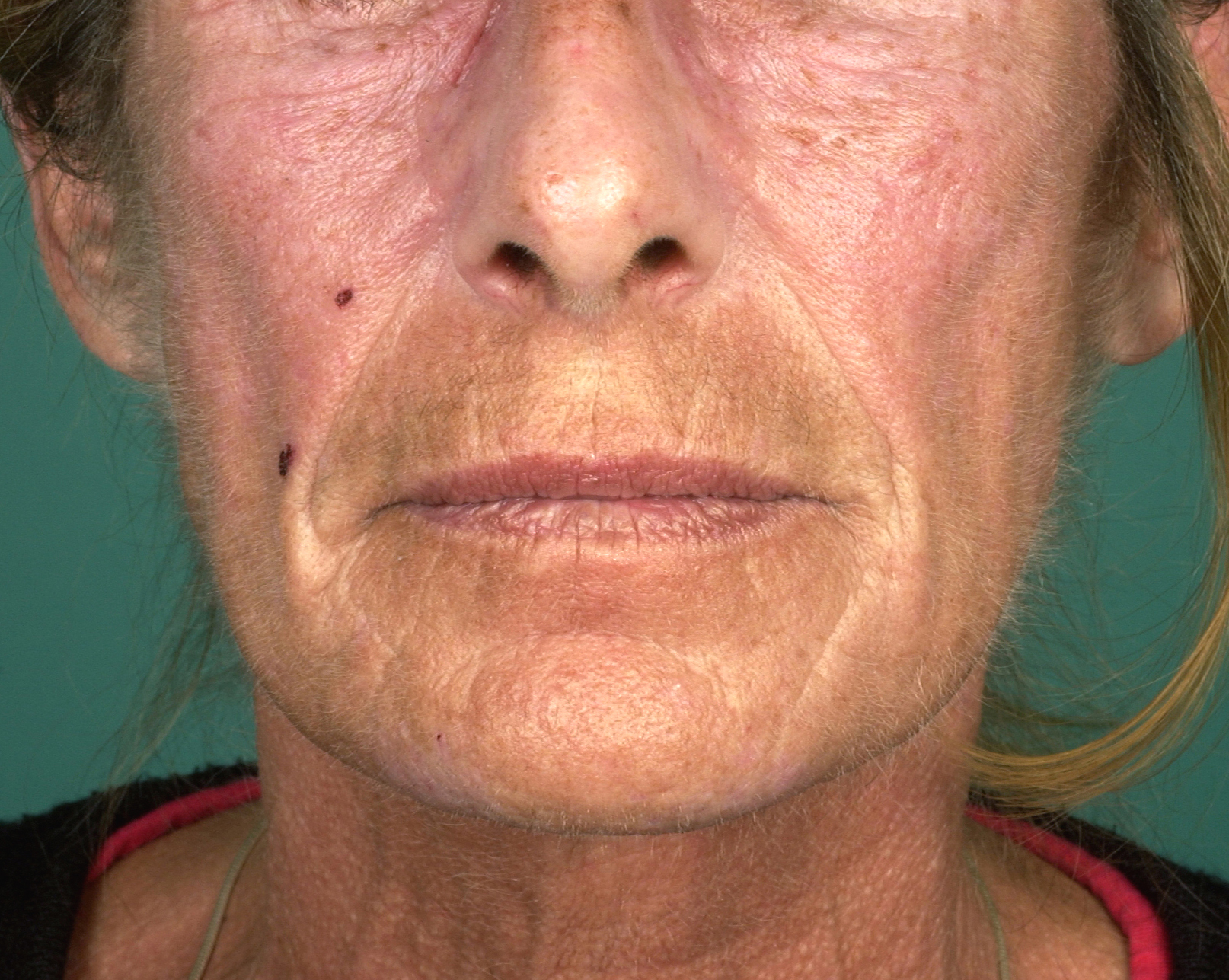 porphyria cutanea tarda