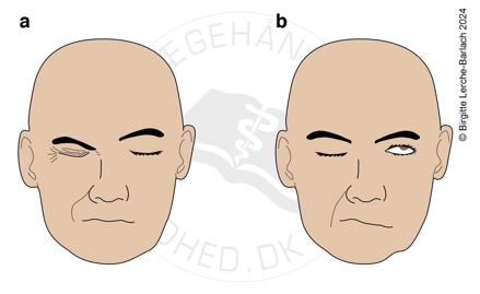 Tegning af facialisparese let og svær grad