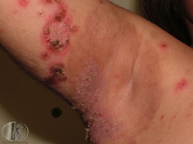 impetigo-mange-ben-fod