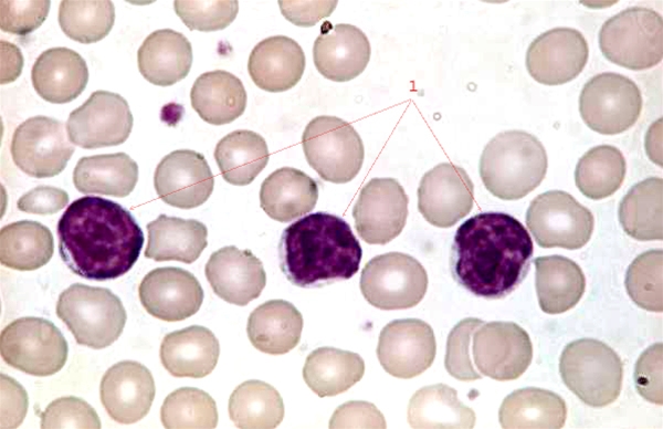 blod-kronisk lymfatisk leukemi x 100