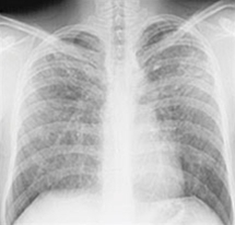 lunger-sarkoidose-roentgen 2