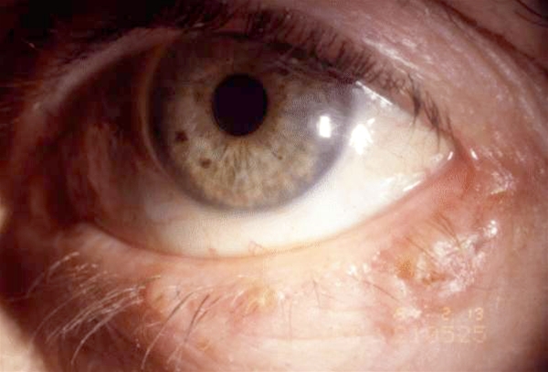 730 2 basalcellecarcinom jpg