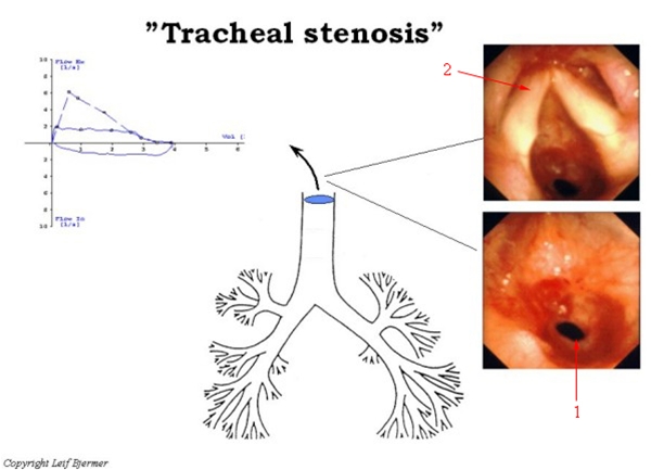 lunge-trakeal stenose